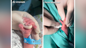 Хирурги удалили шестой палец новорожденному в Подмосковье