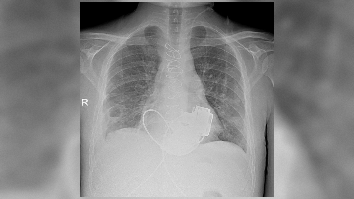 Человек без пульса: в Петербурге к выписке готовят уникального пациента