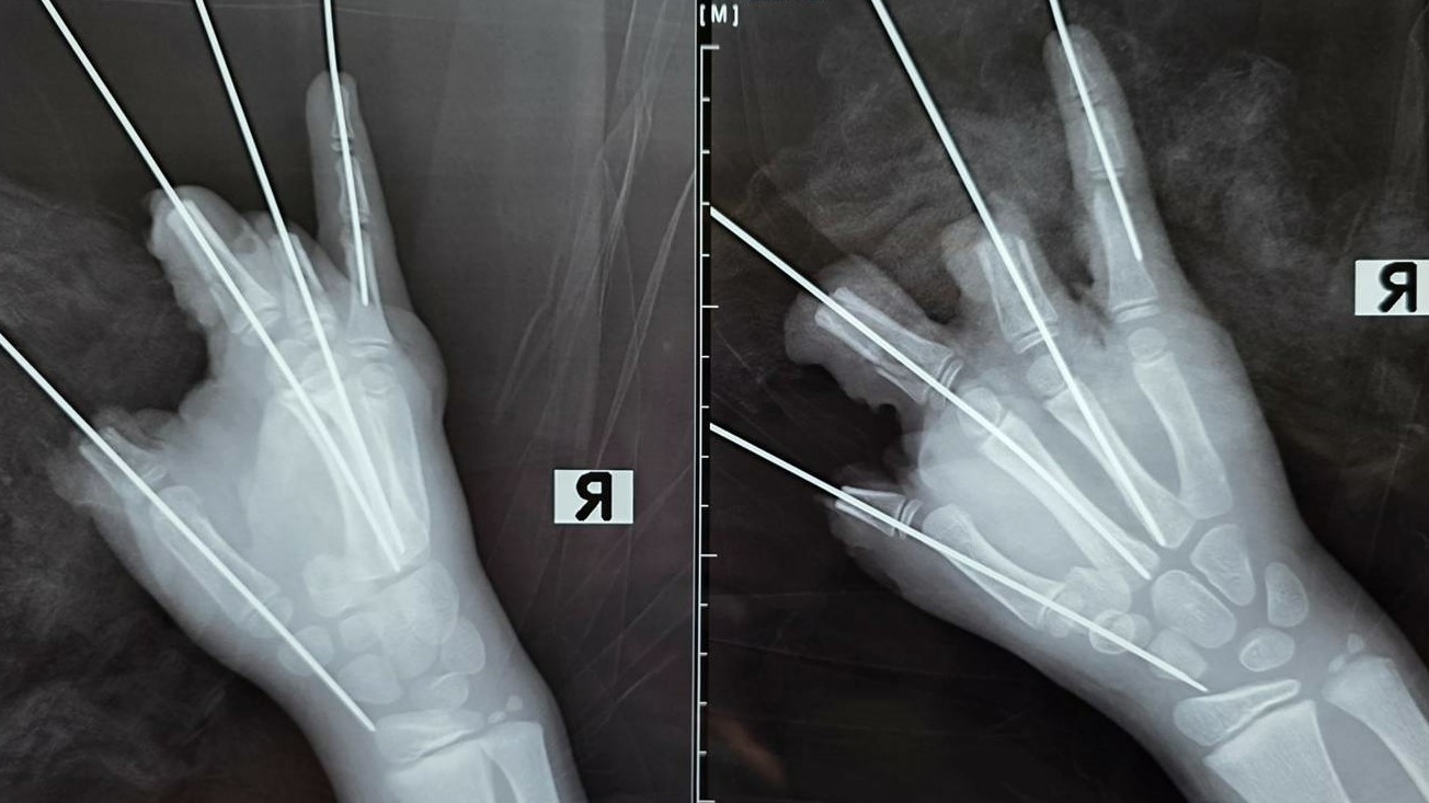 Петарда оторвала ребенку четыре пальца: петербургские врачи сражались за руку мальчика пять часов