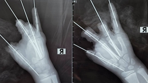 Петарда оторвала ребенку четыре пальца: петербургские врачи сражались за руку мальчика пять часов