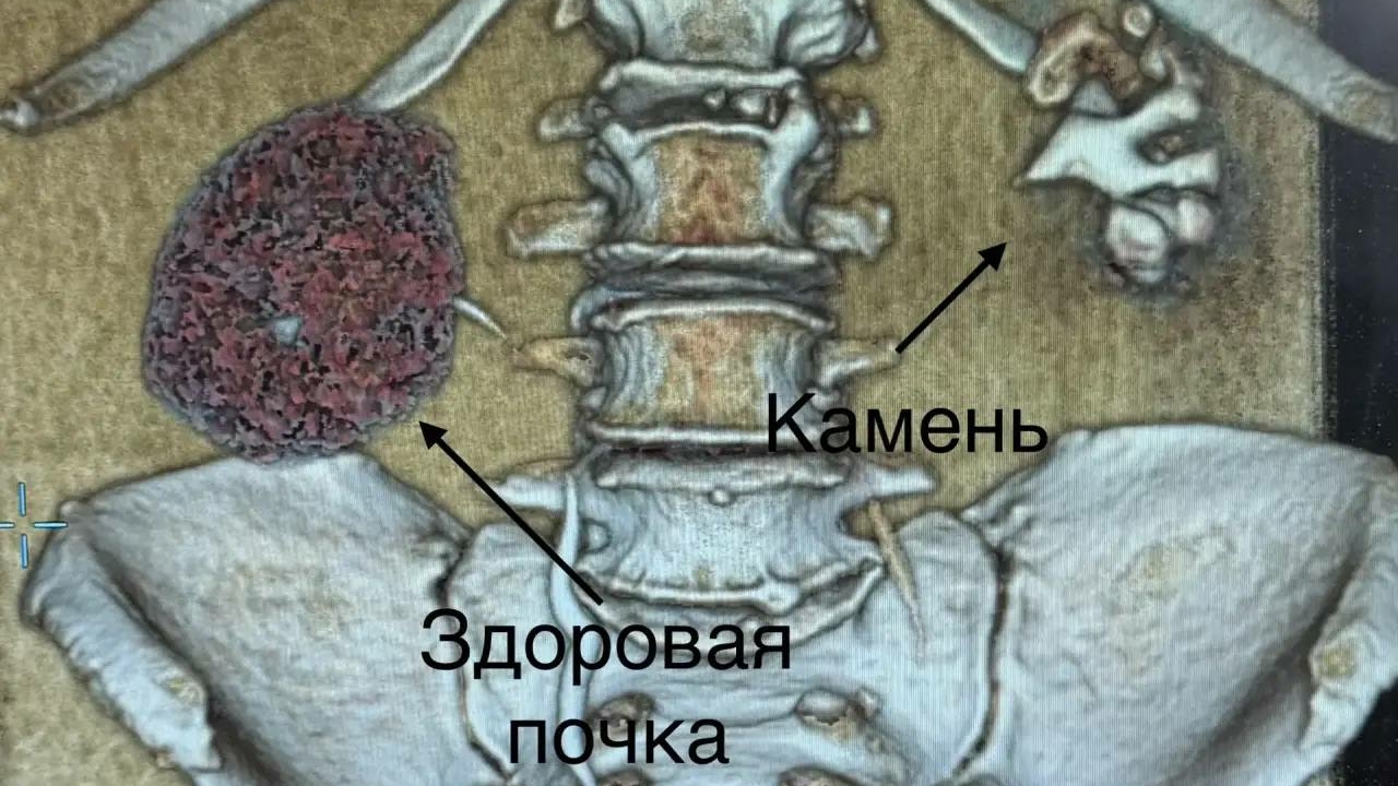 Петербурженке удалили почку из-за разрушенного гигантского «коралла»