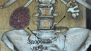 Петербурженке удалили почку из-за разрушенного гигантского «коралла»